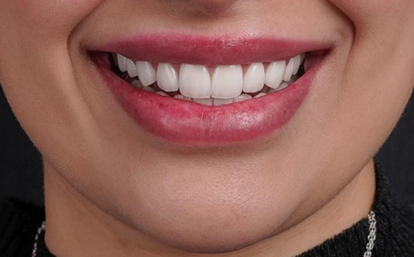 Smile Makeover Options Before The Big Day
