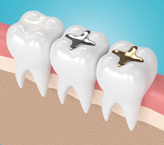 Irving Composite Fillings