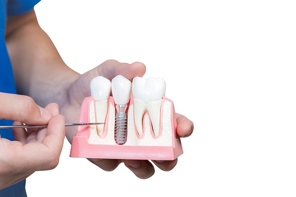 How Long Do Dental Implants Crowns Last?