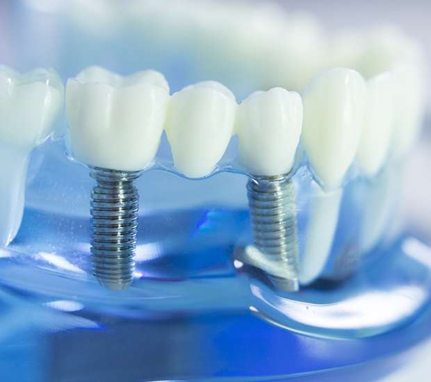 Irving Dental Implants