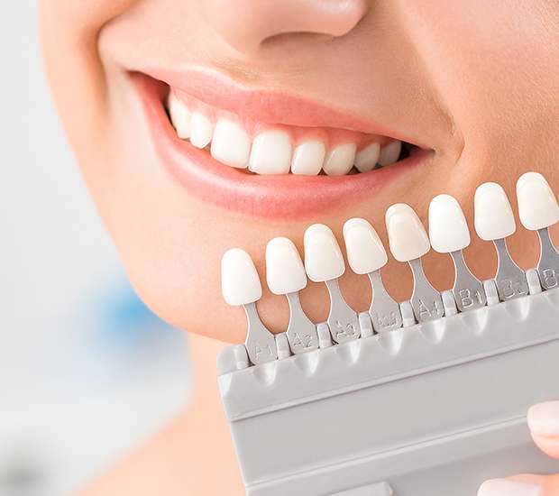 Irving Dental Veneers and Dental Laminates